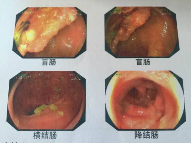 结肠癌同时性肝转移治愈案例,同时性肝转移和异时性肝转移