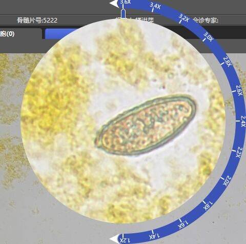 胆囊里面有虫怎么办,胆囊有虫什么症状