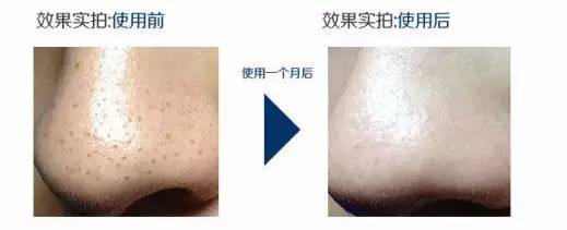 收缩毛孔省钱方法,收缩毛孔超级有效