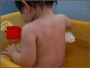 幼儿急疹出疹子期间注意事项,发烧以后出疹子需要注意什么