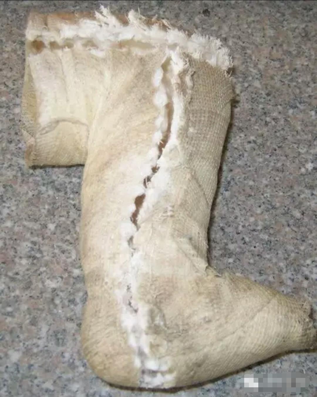 先天性马蹄足内翻可以治愈吗,马蹄足和足内翻是一样的吗