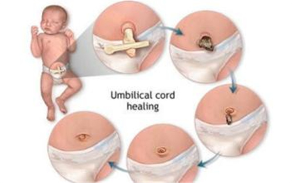 新生儿无尿护理措施,新生儿肚脐护理必备