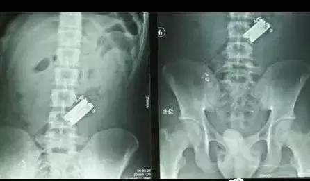 X光片里的体内异物，简直大开眼界