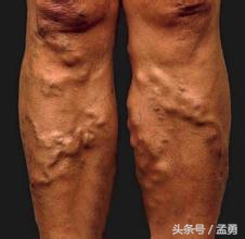 静脉曲张保健方法图解,静脉曲张养生调理最好方法