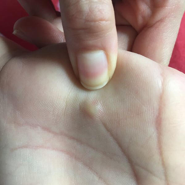 手掌起小疙瘩几个小时就消失了,手掌疙瘩