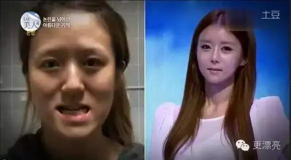 日本整形与韩国整形对比,为什么日本整形不如韩国整形