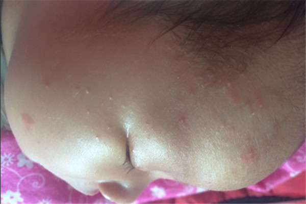 湿疹的针灸绝招,100天宝宝脸上长湿疹怎么护理