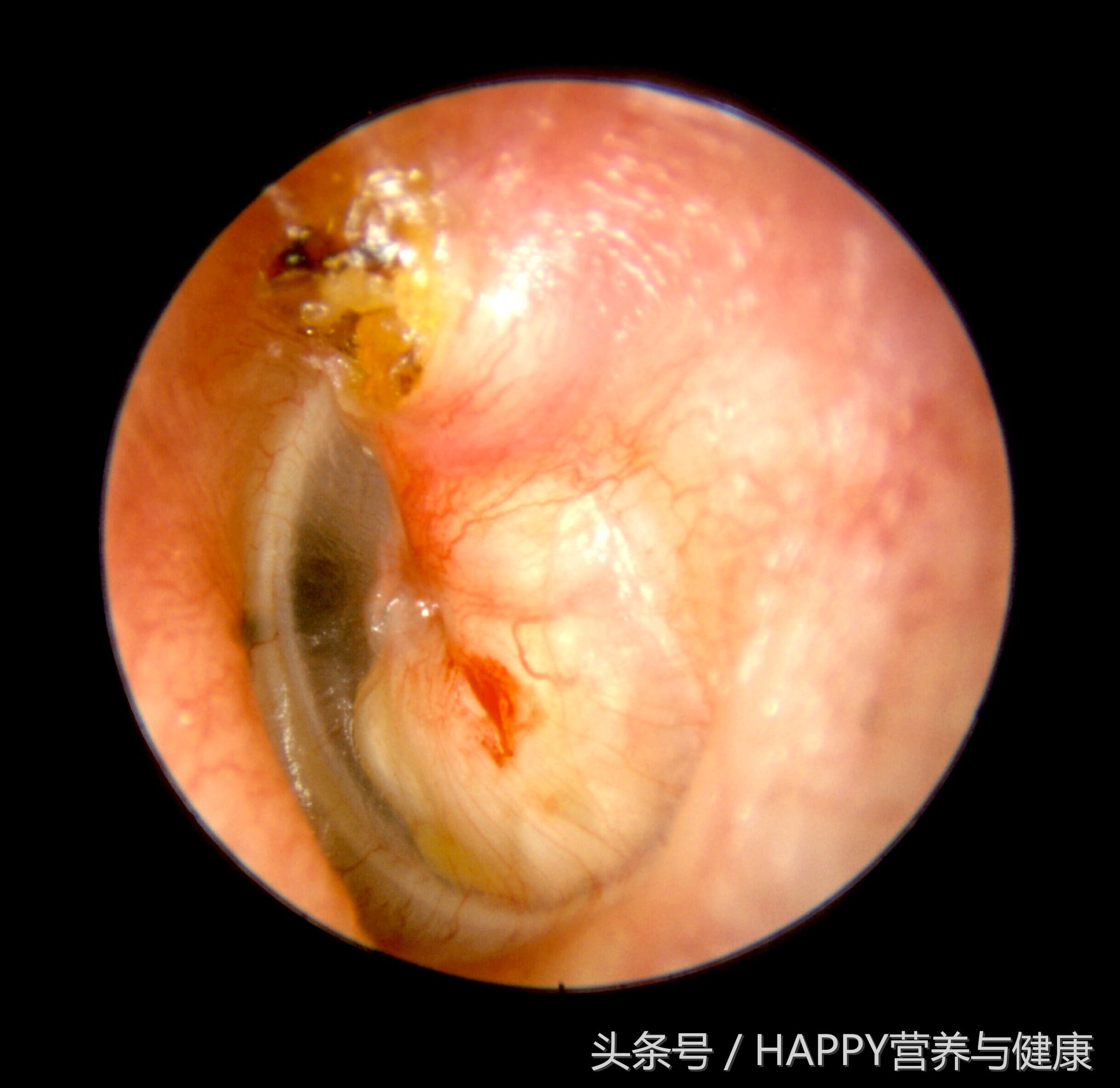 耳朵细菌感染吃什么药,耳朵细菌感染发炎了