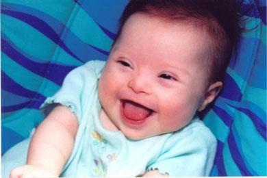 患有唐氏综合征的宝宝,唐氏综合征宝宝越吃越瘦