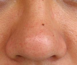 毛孔粗大有黑头怎么办学生,毛孔粗大有黑头怎么办