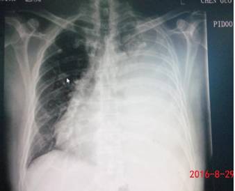 心梗后胸腔积液怎么办,心梗胸腔积液