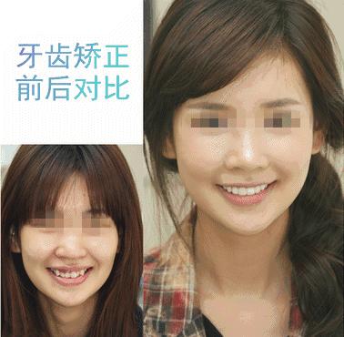 牙齿不齐可以戴隐形牙套吗,牙齿不齐一定要戴钢牙吗