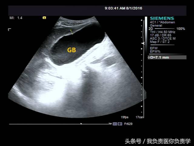 楂樻墜杩涢樁鑵拌吂璁粌,鑳嗗泭缁撶煶绌垮瓟鐥囩姸