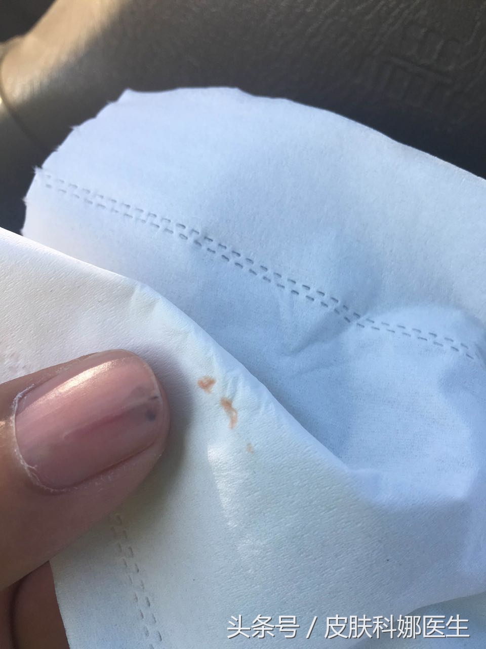 指甲里扎了个刺没重视一年后会痛,指甲里像扎了竹签一样痛什么原因