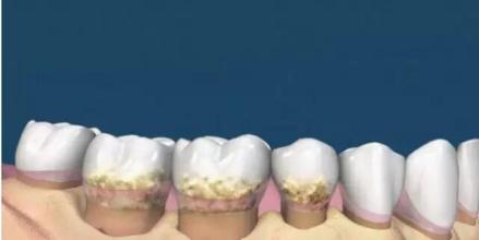 牙根黑色硬块是什么,牙根出现黑色小点点