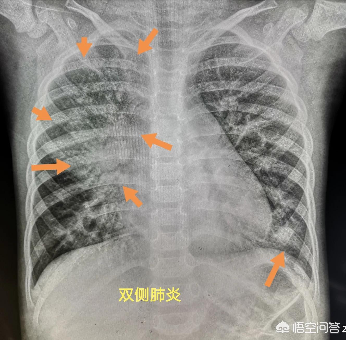 小孩得了肺炎需要打疫苗吗,小孩得了肺炎要打疫苗吗