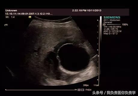 楂樻墜杩涢樁鑵拌吂璁粌,鑳嗗泭缁撶煶绌垮瓟鐥囩姸