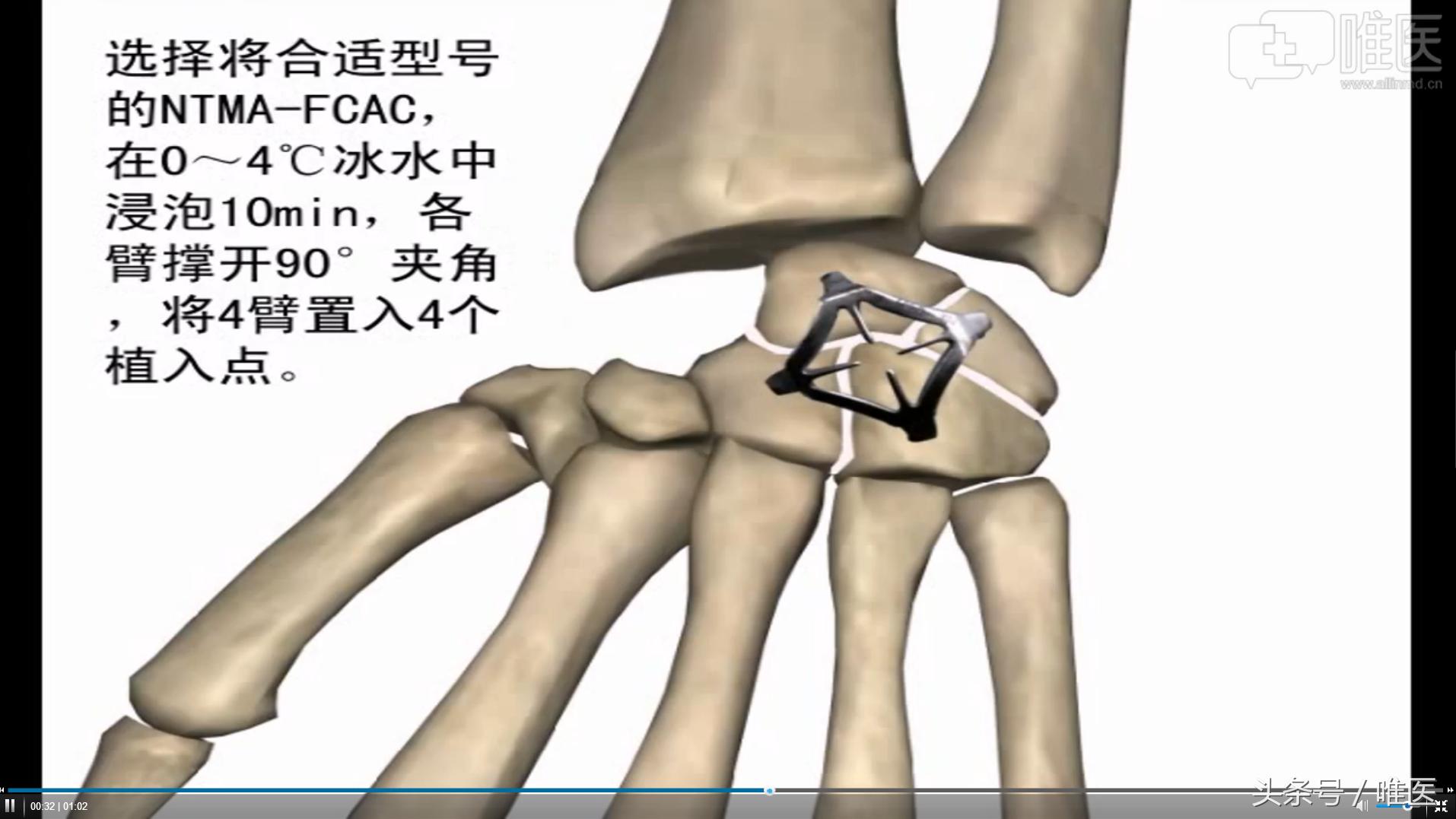 月骨舟骨半脱位手术,手腕舟骨月骨周围脱位要多久康复