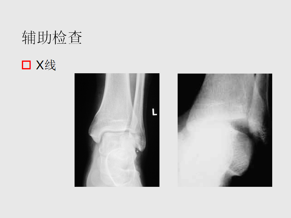脚崴了怎么办判断是否骨折,脚崴了怎么办视频