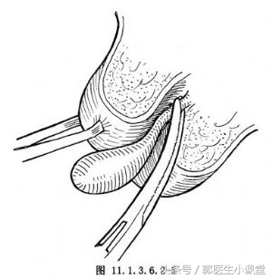 宫颈息肉影响正常怀孕吗,怀孕宫颈息肉会流浅红色分泌物