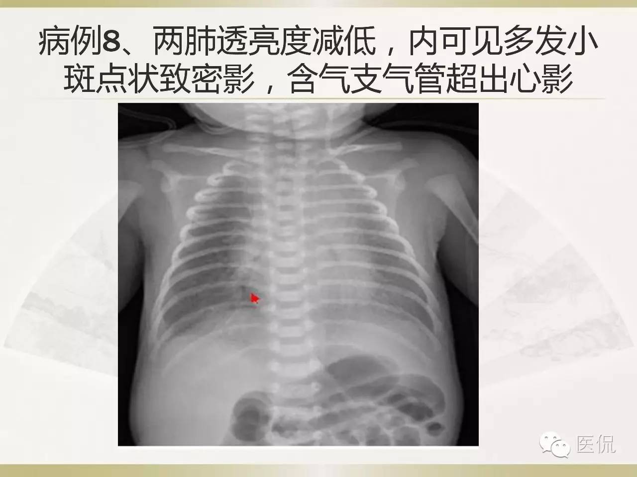「资料丨医看分享」南边老师肺部群：新生儿透明膜病（HMD）医学影像