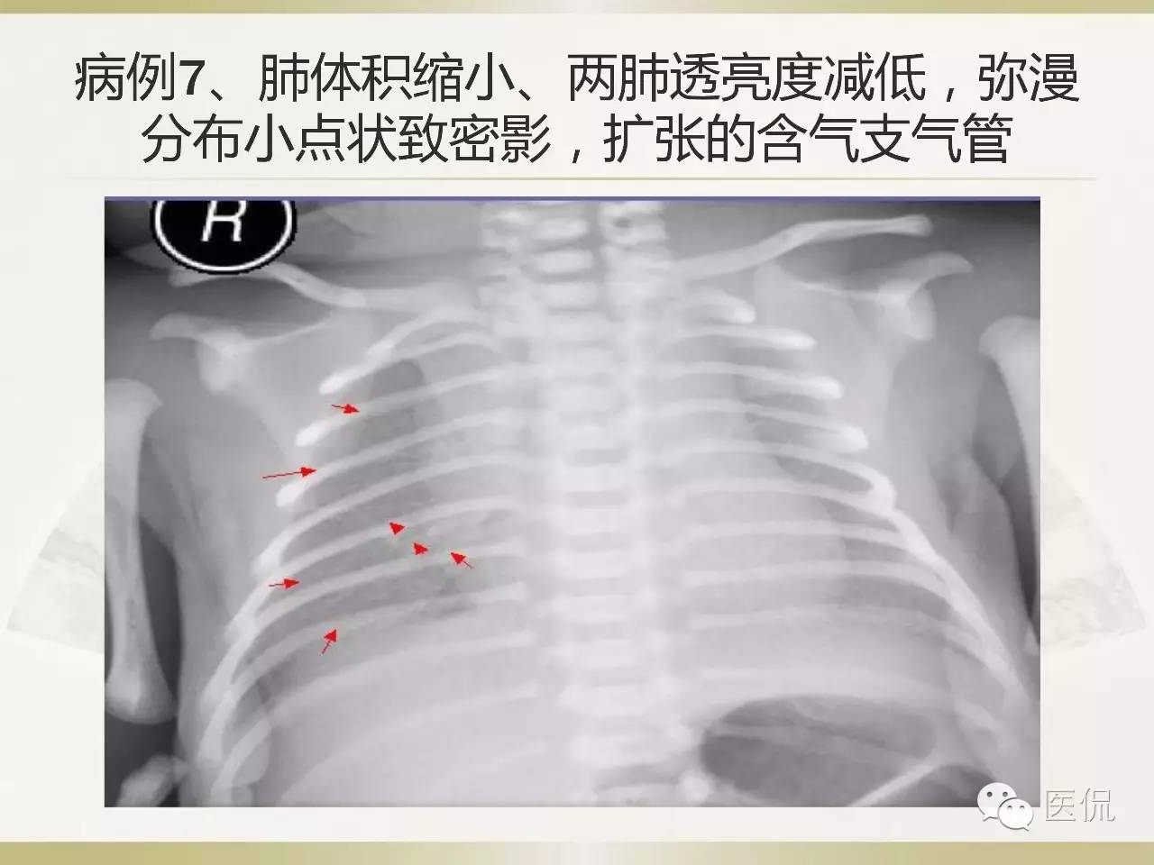 「资料丨医看分享」南边老师肺部群：新生儿透明膜病（HMD）医学影像