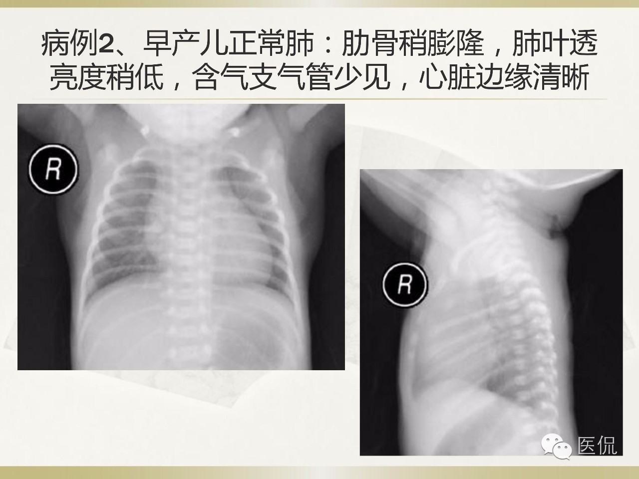 「资料丨医看分享」南边老师肺部群：新生儿透明膜病（HMD）医学影像