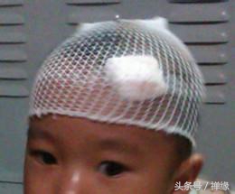 宝宝摔伤淤青如何消除,宝宝摔伤了怎么处理好得快