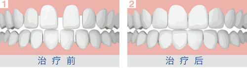 牙缝大贴面修复,牙缝大修复神器