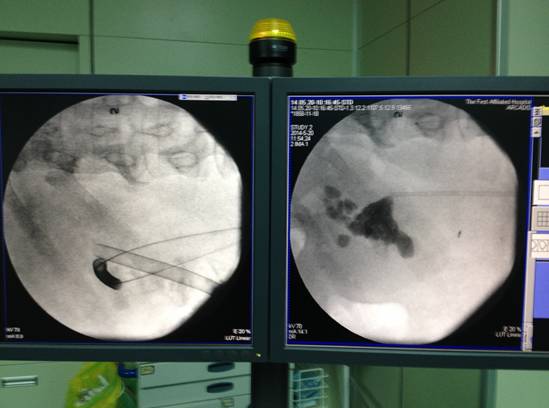 微创肾镜下肾结石碎石取石术,经皮肾镜肾结石激光碎石全过程