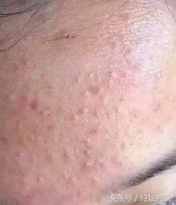 闭合性粉刺怎么去除阿达帕林,闭合性粉刺怎么去除额头