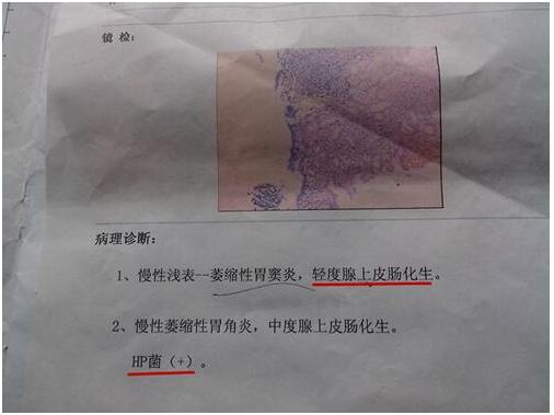 胃镜检查一定要活检才知道胃癌吗,胃镜活检怎么看出胃癌