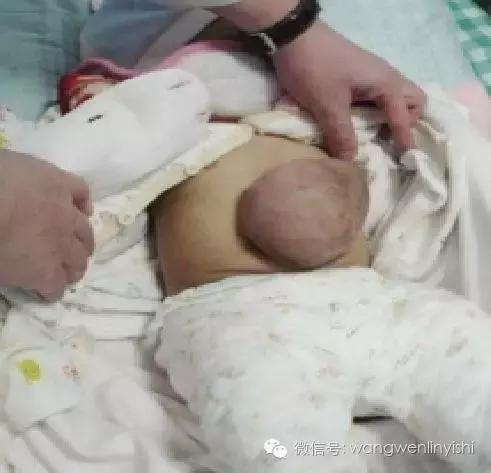 图与真相：什么是胸骨裂？