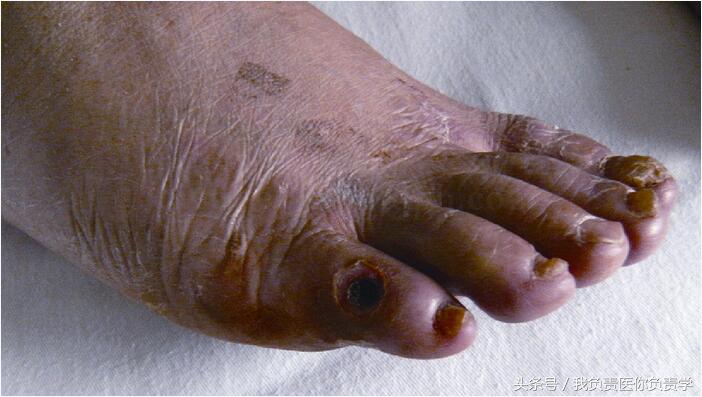 肾移植后坏死能活多久,肾移植后常见的感染部位有哪些