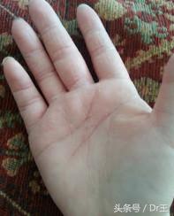 湿疹抹药怎么不见好,湿疹为何擦了药更严重了