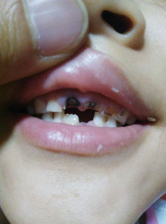 宝宝乳牙神经坏死会影响换牙吗,乳牙龋齿严重牙神经坏死