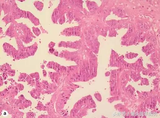 卵巢肿瘤穿刺活检结果,卵巢囊肿穿刺从哪穿刺