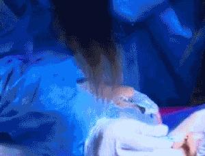 日本纳米无痕双眼皮加开眼角,纳米无痕双眼皮15天恢复图