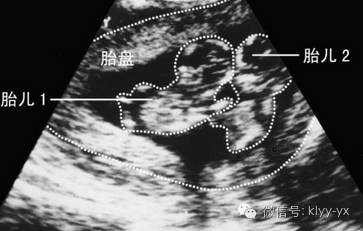 「分娩前后」头胎剖二胎想顺？看看您符合条件吗？