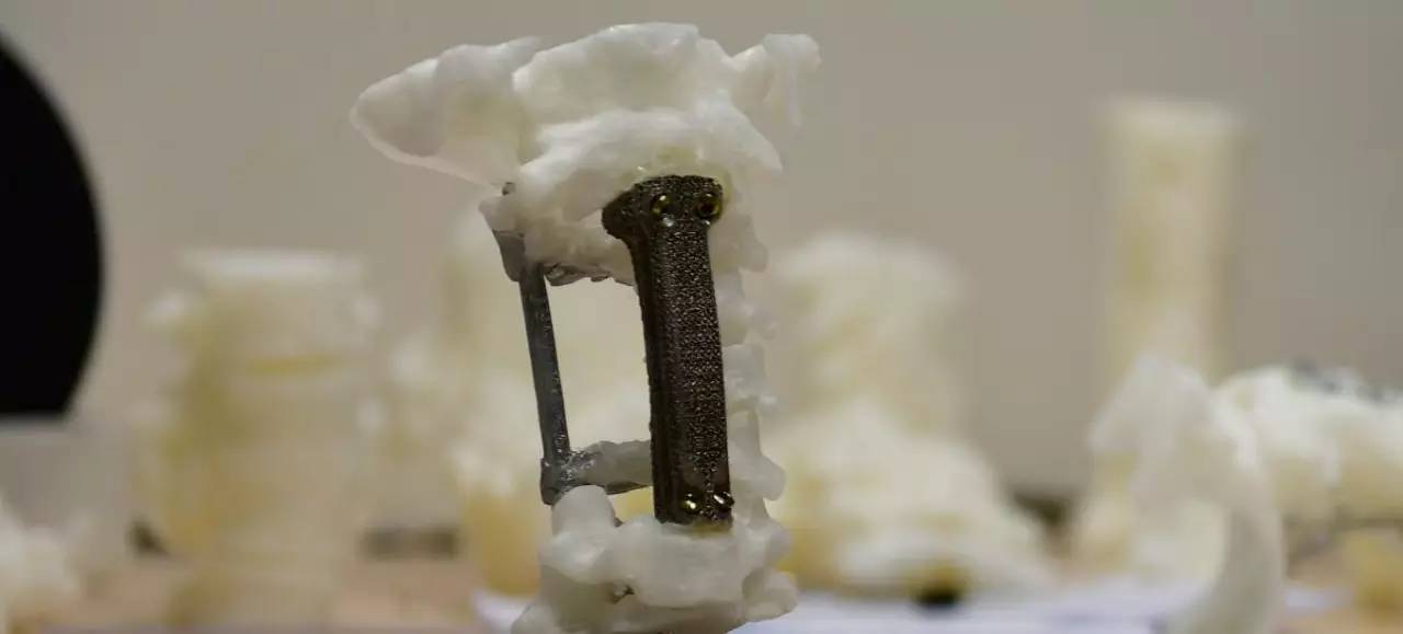 3d打印技术助骨科精准手术,3d打印技术在骨科的应用