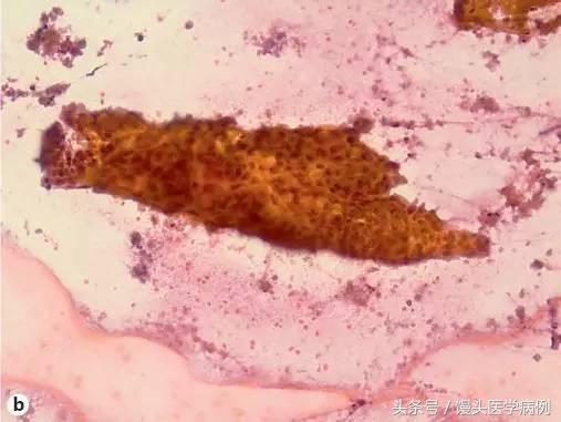 卵巢肿瘤穿刺活检结果,卵巢囊肿穿刺从哪穿刺