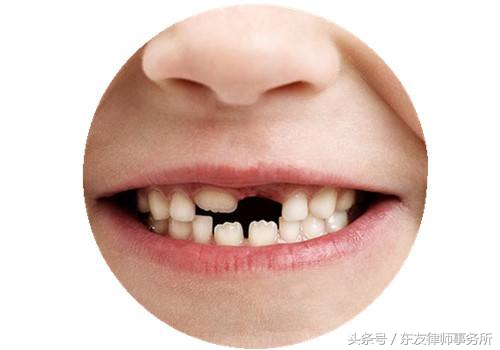 在学校被同学撞到磕掉牙齿,孩子在学校被同学绊倒牙齿磕坏了