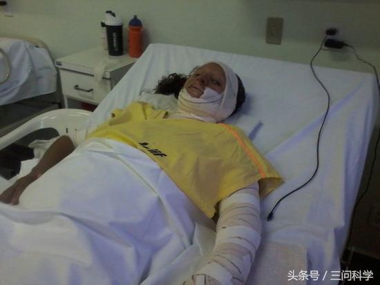 烫伤了不痛,鱼皮治疗烫伤疤痕可以吗