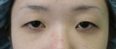 双眼皮的十大问题图,双眼皮割得不好怎么办