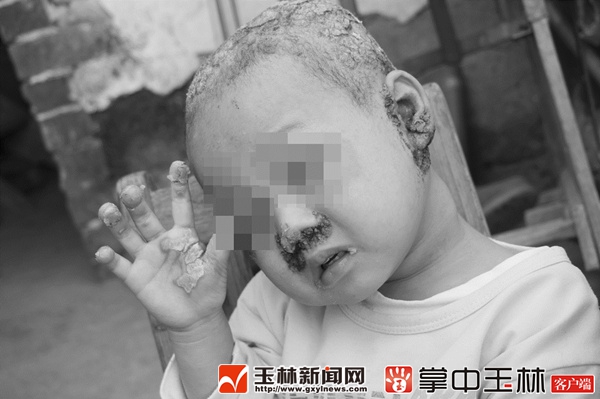 瘆人！容县4岁男孩“头部龟裂”