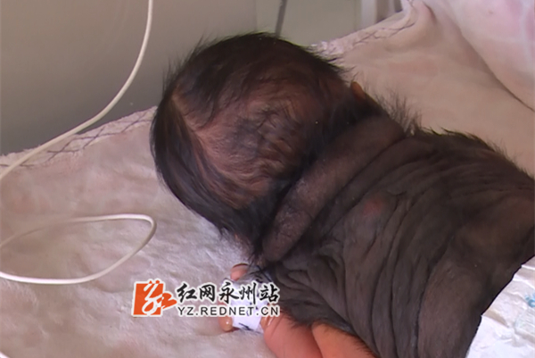宁远男婴疑患兽皮痣皮肤被“黑衣”覆盖