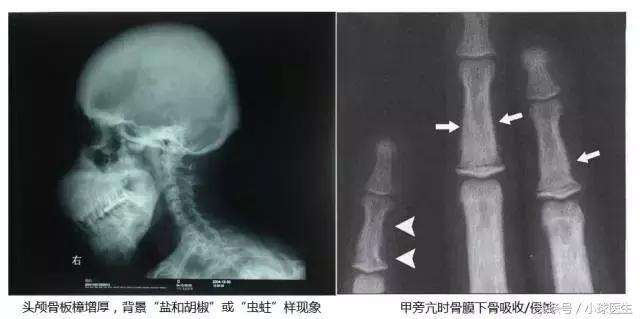 继发性甲状旁腺功能亢进是什么病,继发性甲状旁腺功能亢进怎么治