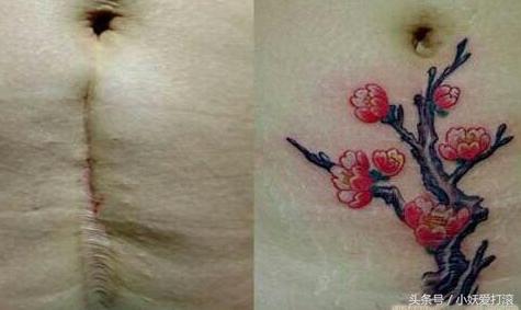 屁股也长妊娠纹,孕中期长妊娠纹用什么祛妊娠纹