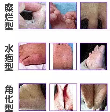 脚气难愈春天中医教你如何治脚气,脚气病的分型