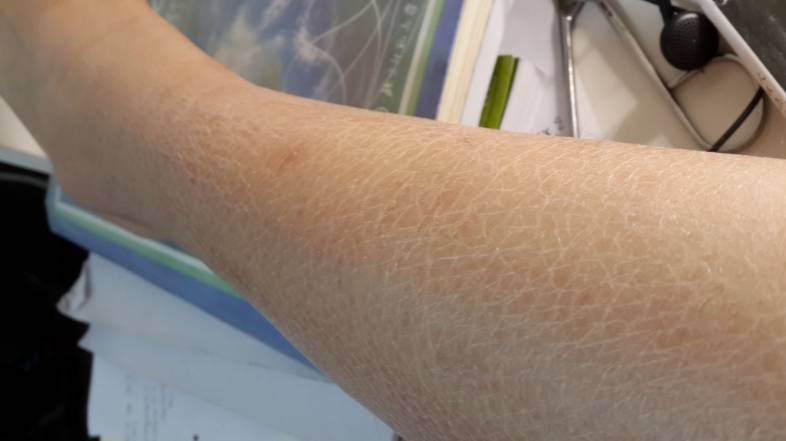 美人鱼皮肤护理,不吃鱼皮肤会干燥痒吗